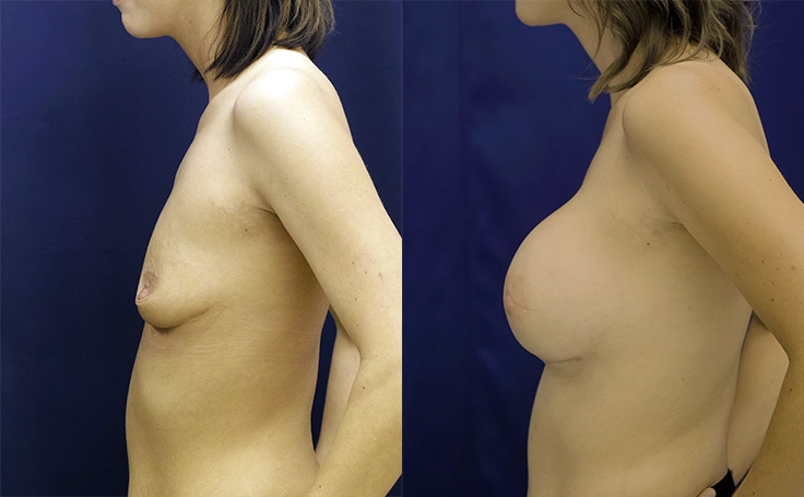 breast aug before and after 450 cc silicone breast implants side view