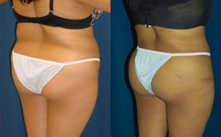 Before and after photo of an actual B-more Butt Lift patient.