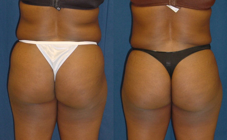 Before and after photo of an actual B-more Butt Lift patient.