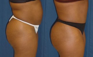 Before and after photo of an actual B-more Butt Lift patient.