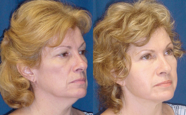 Before and after photo of an actual Facelift patient.