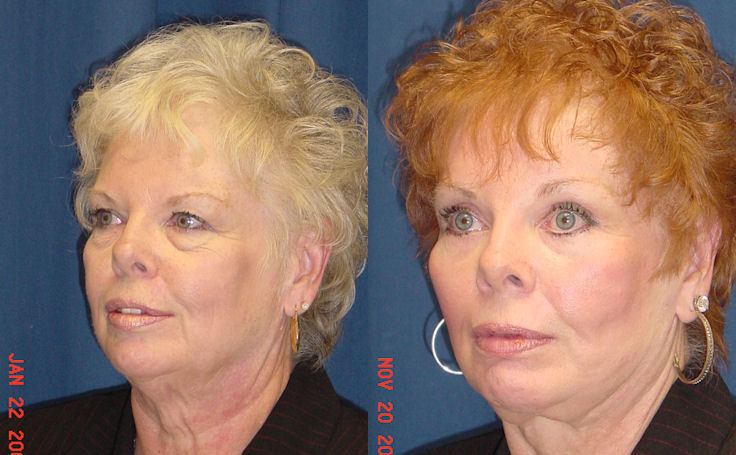 Before and after photo of an actual Facelift patient.