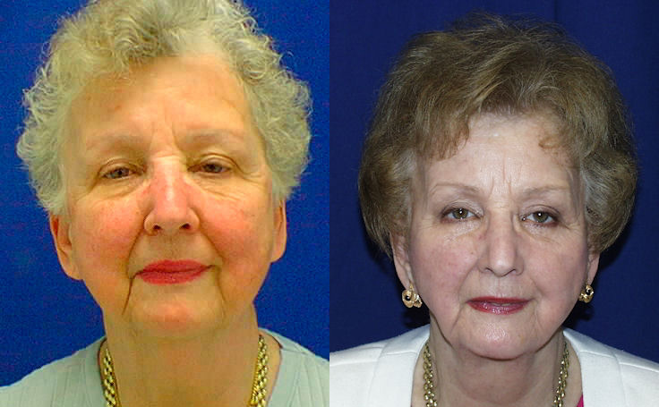 Before and after photo of an actual Facelift patient.