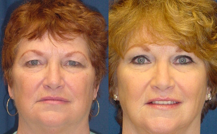 Before and after photo of an actual Facelift patient.