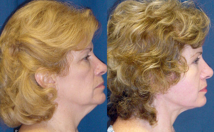 Before and after photo of an actual Facelift patient.