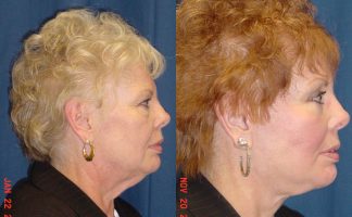 Before and after photo of an actual Facelift patient.