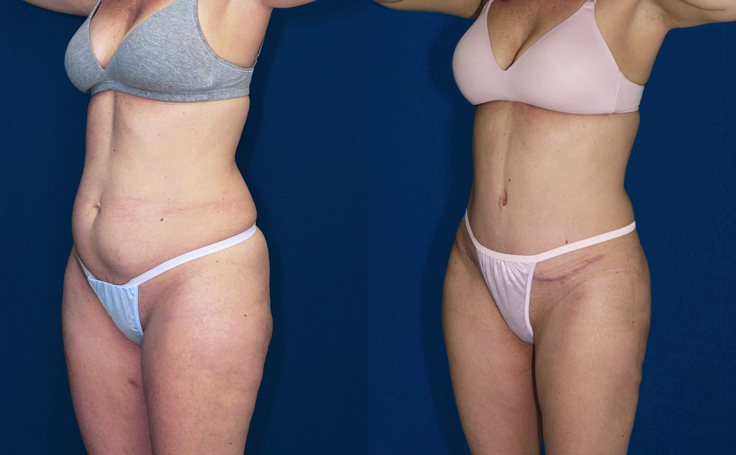 Before and after photo of an actual Tummy Tuck patient.