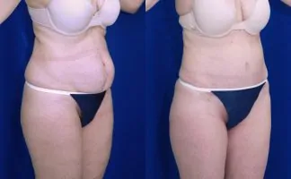 Before and after photo of an actual Tummy Tuck patient.