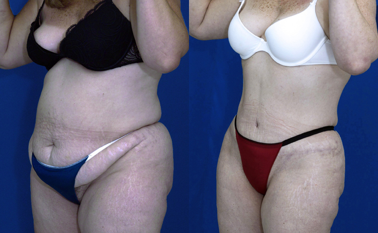 Before and after photo of an actual Tummy Tuck patient.