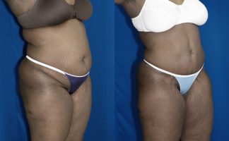 Before and after photo of an actual Tummy Tuck patient.