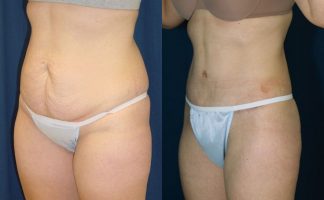 Before and after photo of an actual Tummy Tuck patient.