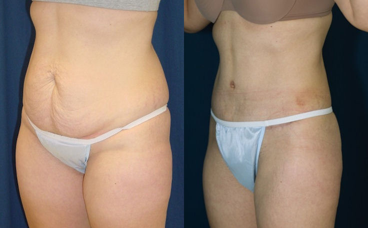 Before and after photo of an actual Tummy Tuck patient.