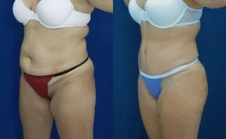 Before and after photo of an actual Tummy Tuck patient.