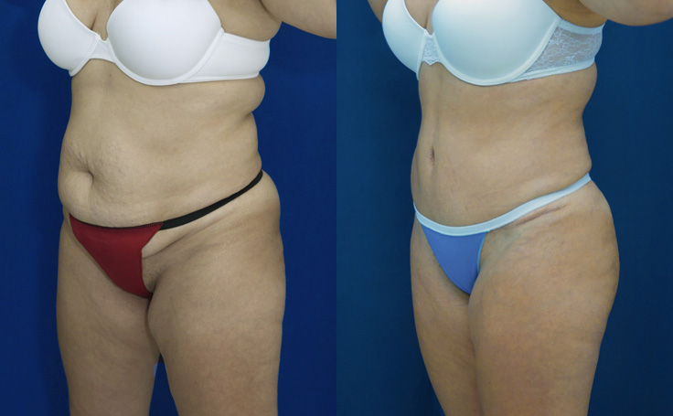 Before and after photo of an actual Tummy Tuck patient.