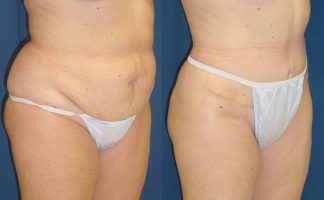 Before and after photo of an actual Tummy Tuck patient.