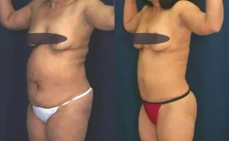 Before and after photo of an actual Tummy Tuck patient.