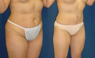 Before and after photo of an actual Tummy Tuck patient.