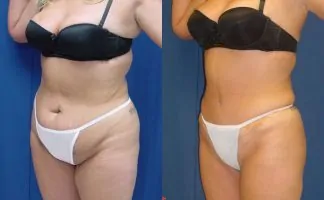 Before and after photo of an actual Tummy Tuck patient.