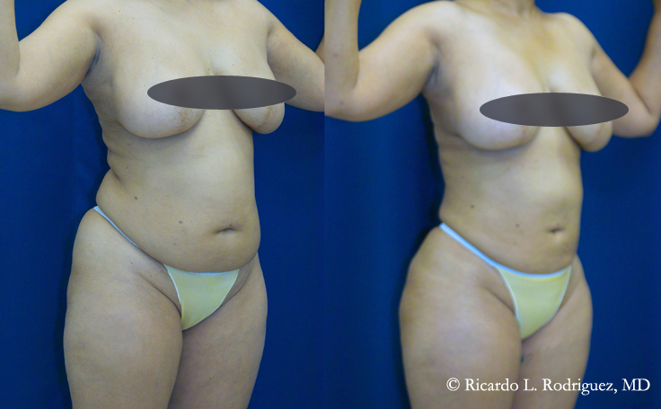 Before and after photo of an actual Tummy Tuck patient.