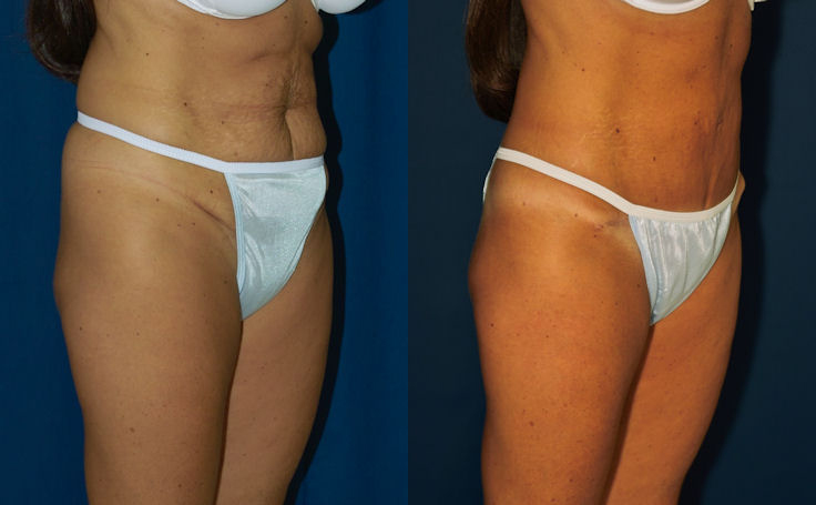 Before and after photo of an actual Tummy Tuck patient.