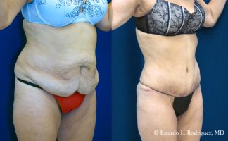 Before and after photo of an actual Tummy Tuck patient.