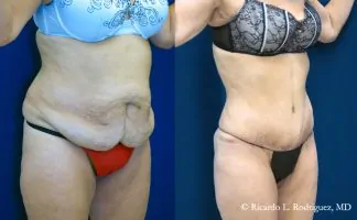 Before and after photo of an actual Tummy Tuck patient.