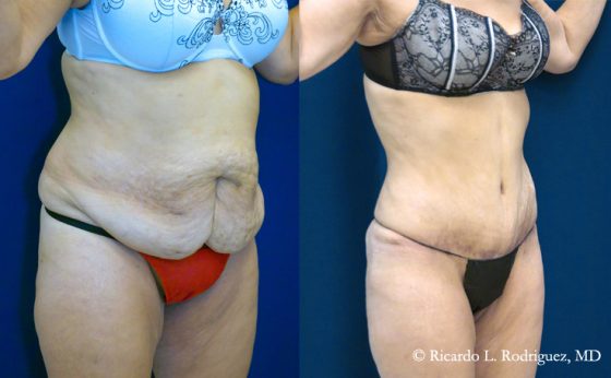 Before & After Lipo of flanks - Dr. Rodriguez, Cosmeticsurg