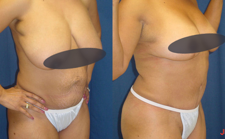 Before and after photo of an actual Tummy Tuck patient.