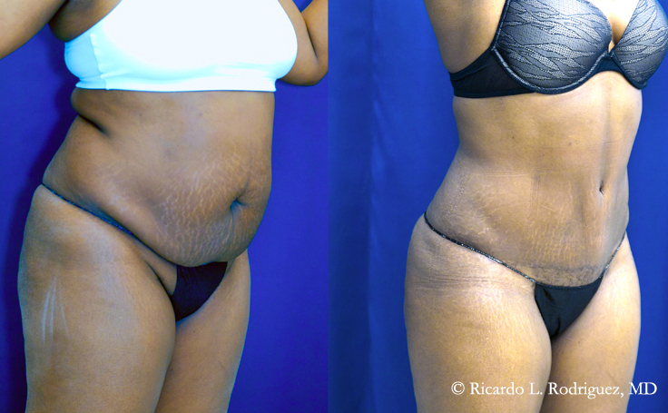 Before and after photo of an actual Tummy Tuck patient.