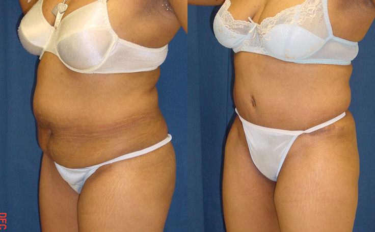 Before and after photo of an actual Tummy Tuck patient.