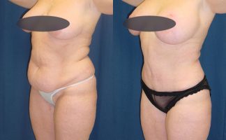 Before and after photo of an actual Tummy Tuck patient.