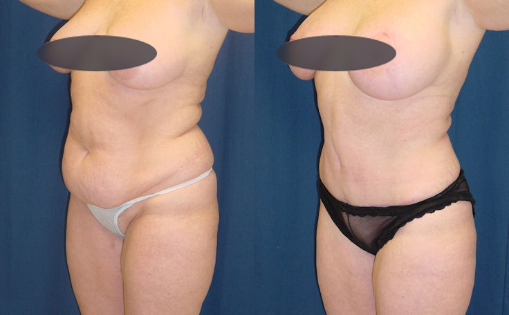 Before and after photo of an actual Tummy Tuck patient.