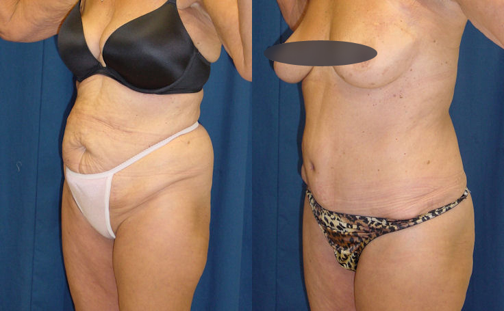 Before and after photo of an actual Tummy Tuck patient.