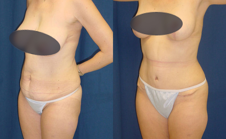 Before and after photo of an actual Tummy Tuck patient.