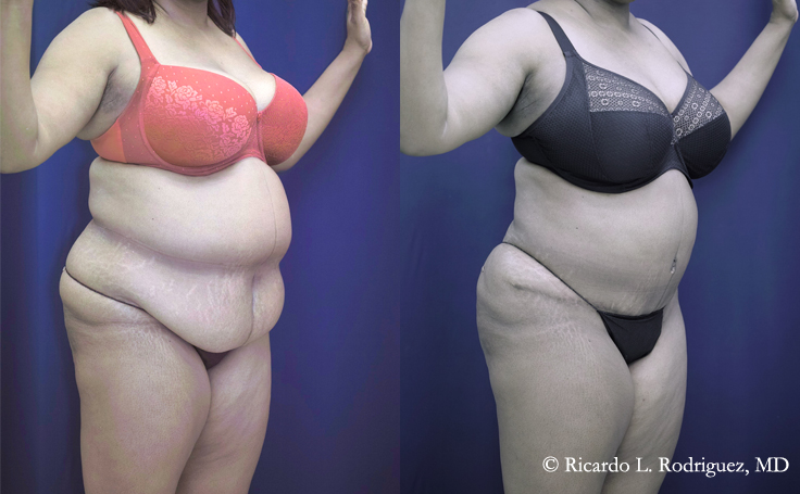 Before & After Lipo of flanks - Dr. Rodriguez, Cosmeticsurg