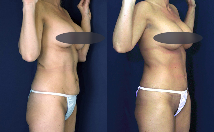 Before and after photo of an actual Tummy Tuck patient.