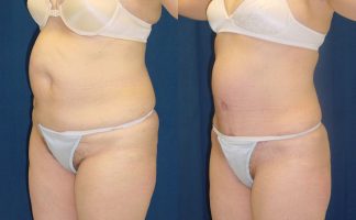 Before and after photo of an actual Tummy Tuck patient.