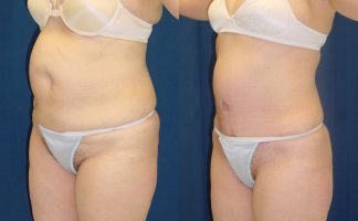 Before and after photo of an actual Tummy Tuck patient.