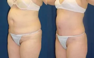 Before and after photo of an actual Tummy Tuck patient.