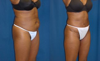 Before and after photo of an actual Tummy Tuck patient.