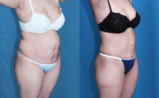 Before and after photo of an actual Tummy Tuck patient.