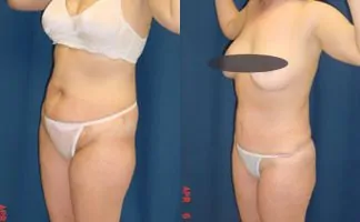 Before and after photo of an actual Tummy Tuck patient.