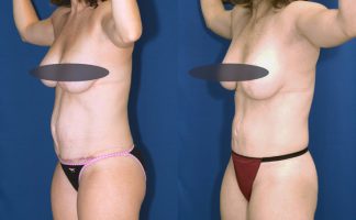 Before & After Lipo of flanks - Dr. Rodriguez, Cosmeticsurg