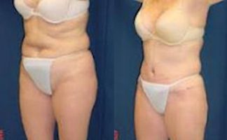 Before and after photo of an actual Tummy Tuck patient.