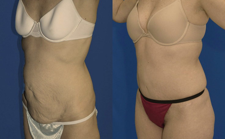 Before and after photo of an actual Tummy Tuck patient.