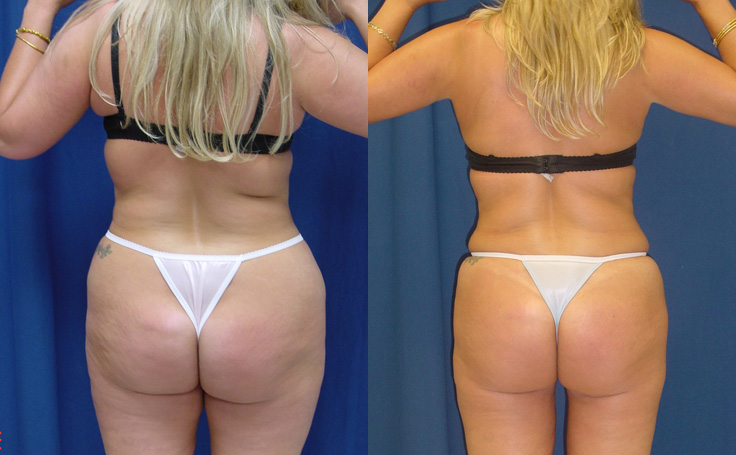 Before and after photo of an actual Tummy Tuck patient.