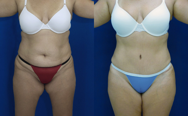 Before and after photo of an actual Tummy Tuck patient.