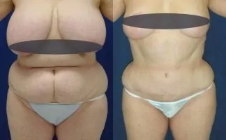 Before and after photo of an actual Tummy Tuck patient.