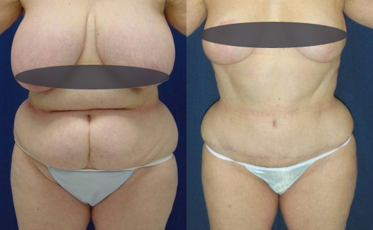 Before & After Lipo of flanks - Dr. Rodriguez, Cosmeticsurg