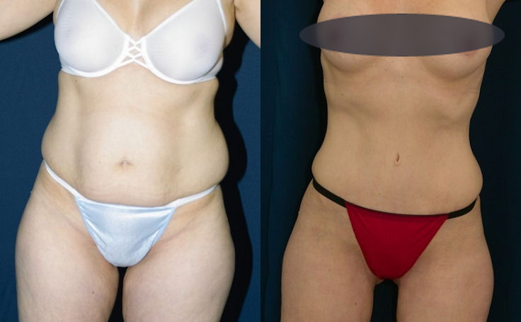 Before and after photo of an actual Tummy Tuck patient.